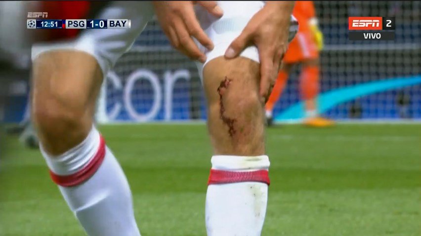 Un choque ha acabado con Müller sangrando por la rodilla. Tuvo que ser atendido, pero sigue jugando.