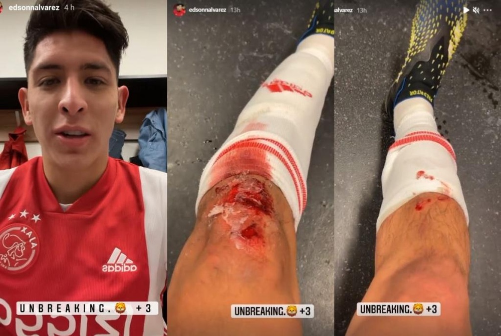 Assim ficou a perna de Edson Álvarez após a vitória. Instagram/edsonnalvarez